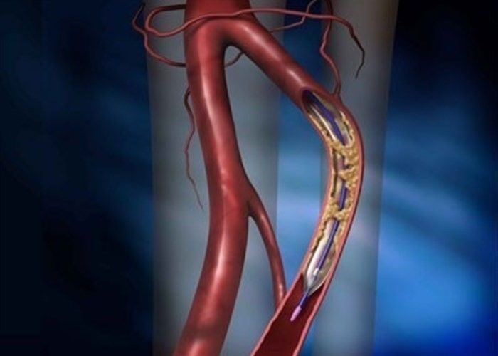 Ангиопластика и стентирование коронарных артерий
